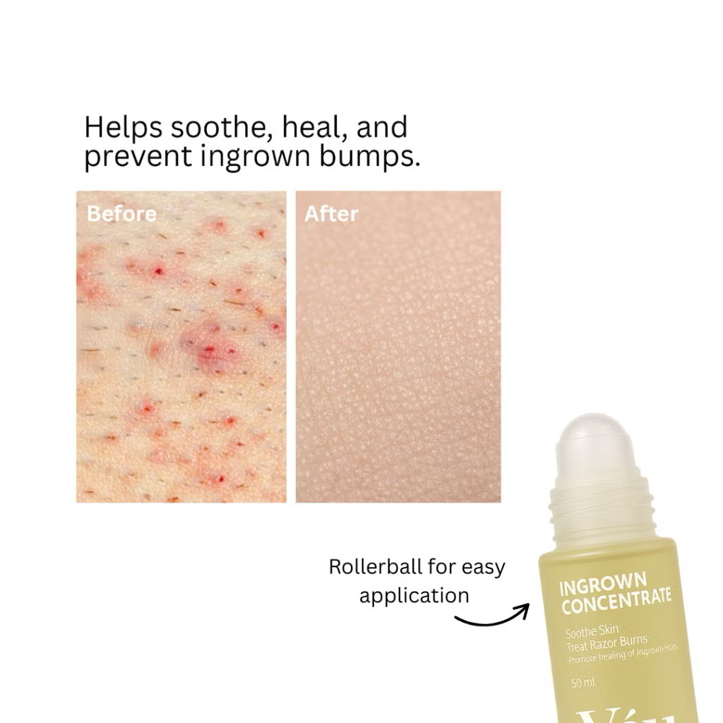 Ingrown Concentrate Oil - Calming relief for Razor Bumps and Ingrown Hair