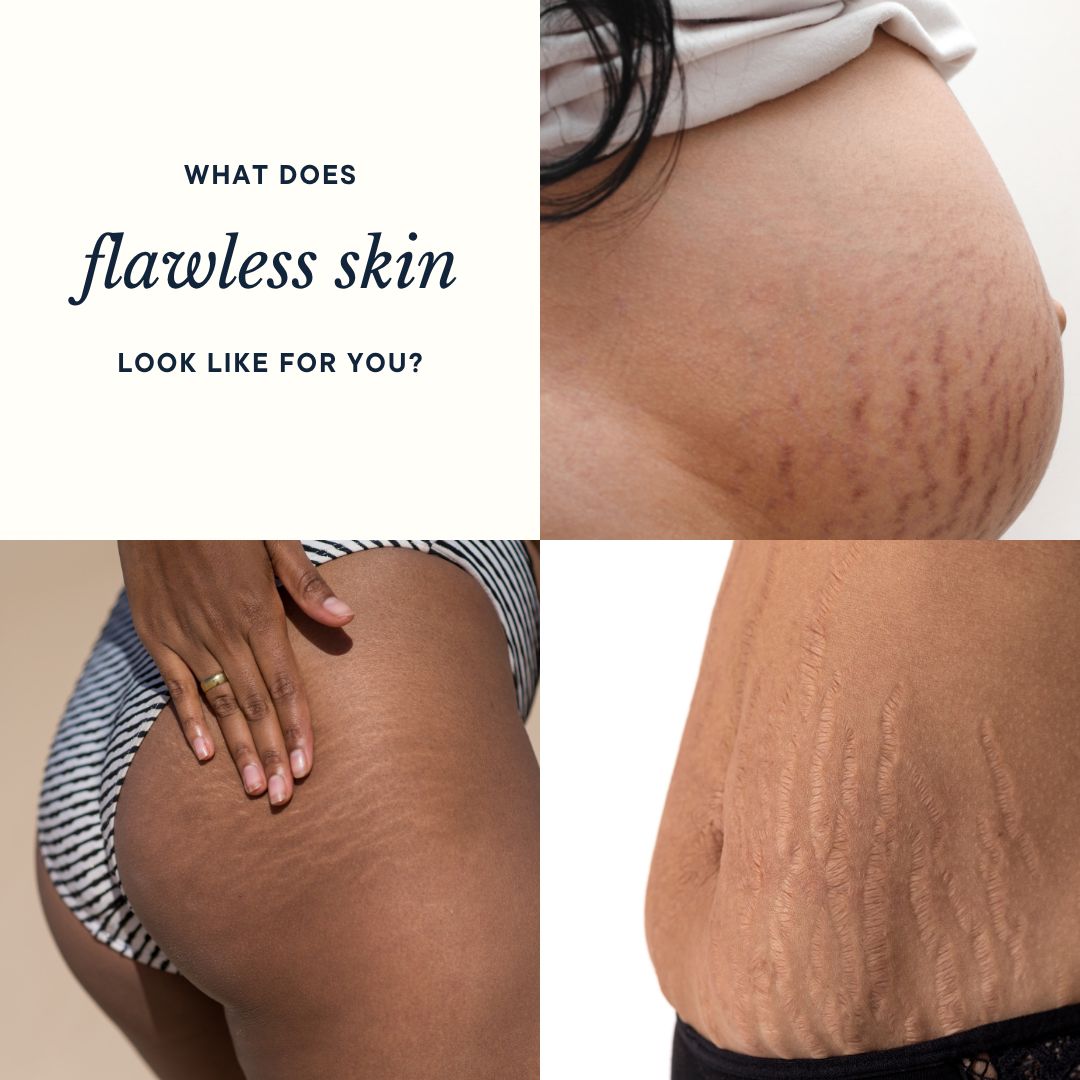 Stretch Mark Be Gone Concentrate Oil Roller Ball- with Rosehip, Jojoba & Tamanu Oil